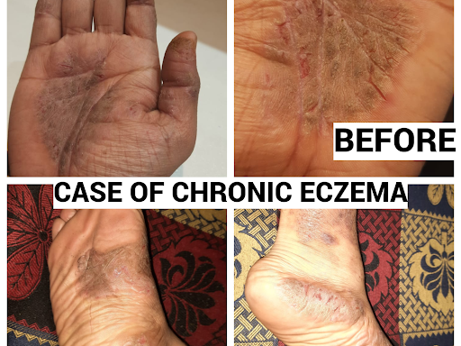 A chronic obstinate case of Eczema after failed steroids treatment cured completely by Classical… post image