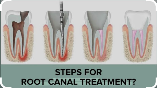 Dr. Aditya at Dr. Aditya Dental Kraft in Crossing Republik offers painless Root Canal Treatment (… post image