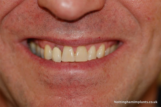 Nottingham Implants - Visual