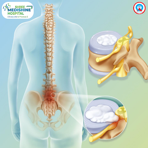 Chronic back pain is a common problem that can affect mobility, sleep, work, and daily activities…