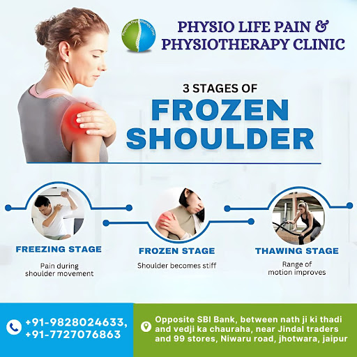 Frozen shoulder, also called adhesive capsulitis, involves stiffness and pain in the shoulder joint. post image