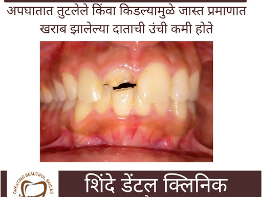 तुटलेल्या किंवा जास्त प्रमाणात किडलेल्या दातांची उंची कमी होते..अशा दातांना रूट कॅनल करून कॅप बसव… post image