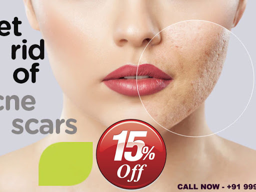 Kara Skin and Hair Clinic Is One Of The Top Brands In India Providing #BestAcneMarksRemoval Visit… post image