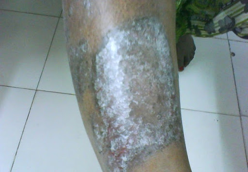 PSORIASIS -HOMEOPATHIC -TREATMENT post image