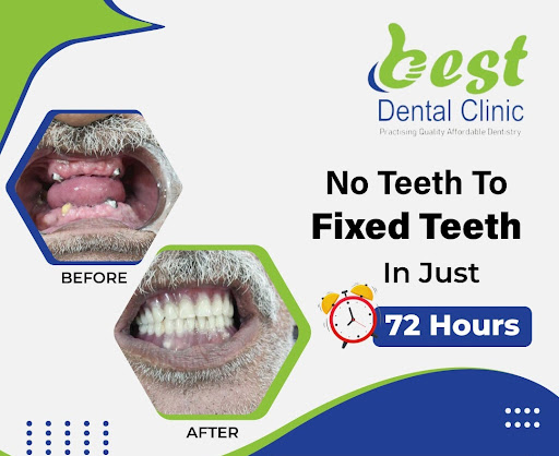 Best Dental Clinic is one of the best dental clinics in Delhi Dwarka. Visit us for the cheapest d… post image