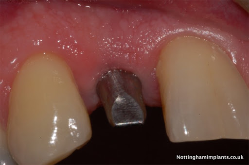 Nottingham Implants - Visual