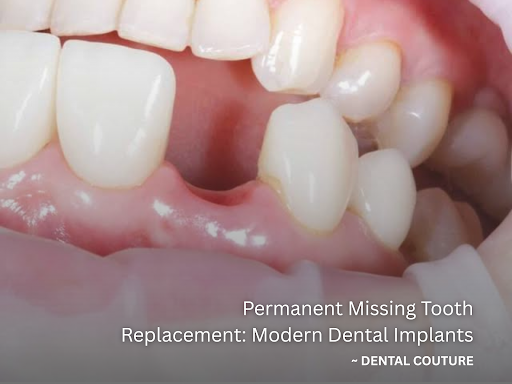 Losing a natural tooth impacts far more than just your visual smile; it gradually undermines your… post image