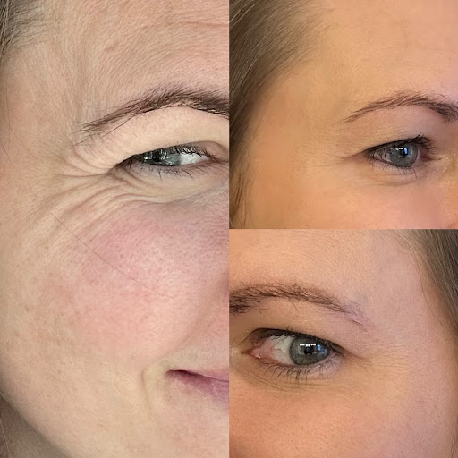 The Mercedes of Botox at Smiley Aesthetics Mount Juliet - Thumbnail