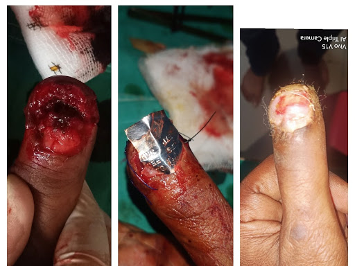 Amazing results On Finger Nail!! post image