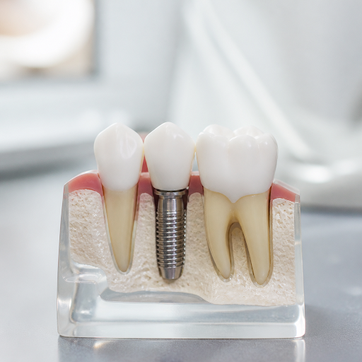 Missing teeth can affect your smile, confidence, and ability to chew comfortably. At AGRAWAL DENT… post image