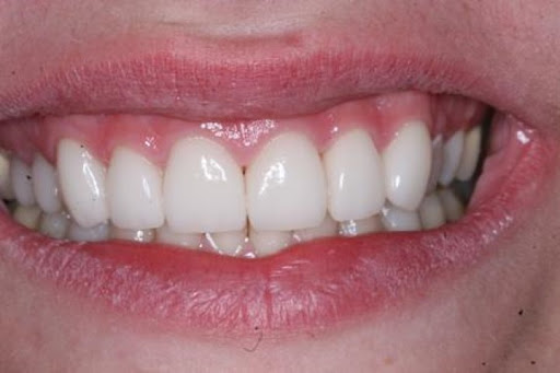 Elite Dental American Fork | Dentist & Implants - Thumbnail
