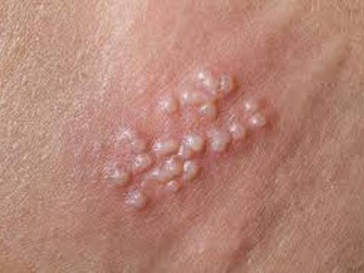 HERPES homeopathic treatment is best for herpes .there is no any side effects.and give permenet c… post image