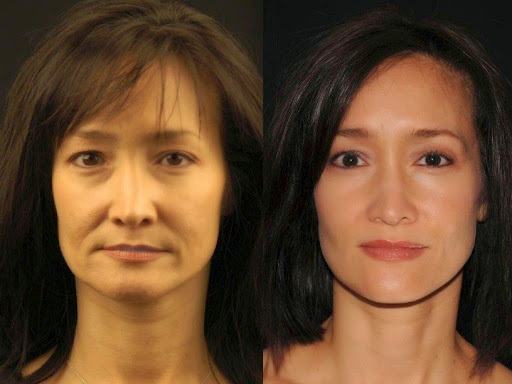 FaceBP Esthetics Gallery - United States
