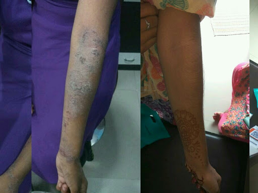 Homeopathic treatment for eczema post image