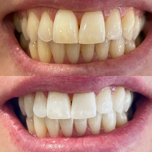 Pearly White