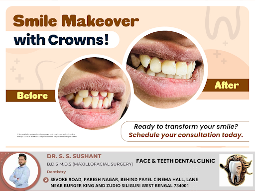 Enhance your smile with dental crowns! Crowns are a great solution for restoring damaged or disco… post image