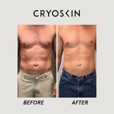 Cryoskin Body