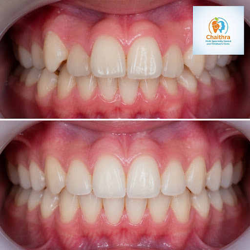 Struggling with crowded teeth, overlapping smiles or difficulty cleaning between teeth? At Chaith… post image