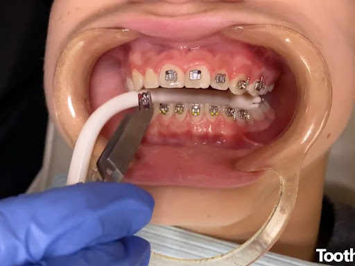 #braces doctor in Gorakhpur, post image