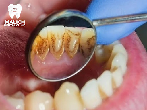Dentures Looking Stained or Smelling Odors? Professional Care! post image