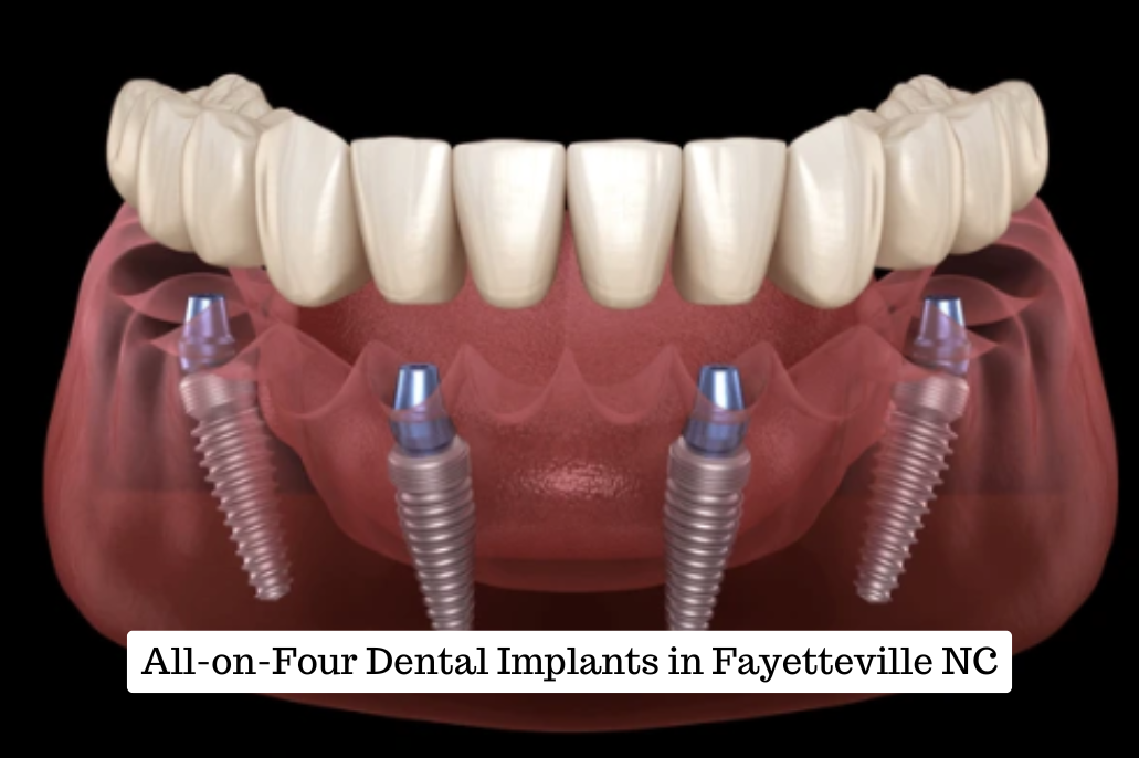 All-on-Four Dental Implants in Fayetteville, NC