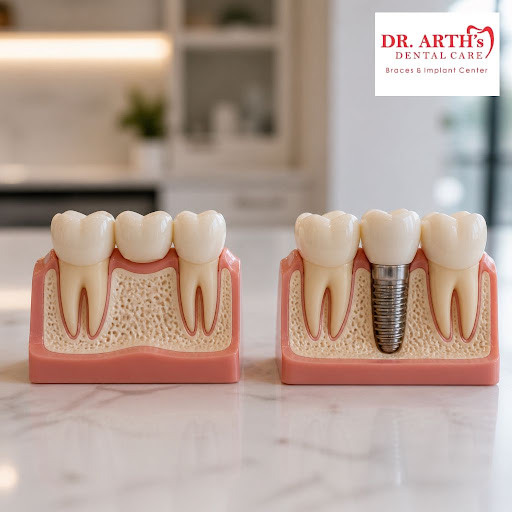 Missing a tooth and confused between a dental implant and a bridge? At Dr Arths Dental Care Brace… post image
