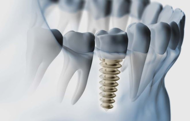 Centru de Implantologie Baia Mare