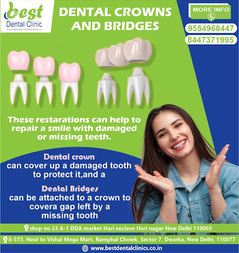 Dental crowns and bridges can help restore your smile. They are designed to cover damaged or deca… post image