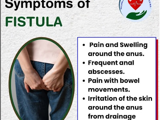 A fistula is an abnormal connection between two body parts, such as an organ or blood vessel and… post image