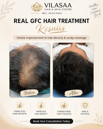 **Real GFC Hair Treatment Results in Ghaziabad ✨** post image