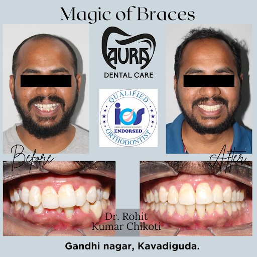 Experience the magic of smile transformation with advanced braces and aligners at Aura Dental Car… post image
