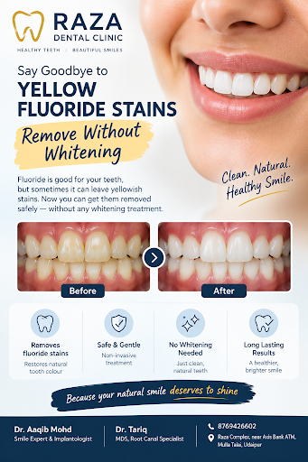 Remove fluoride stains no crown or whitening needed  post image