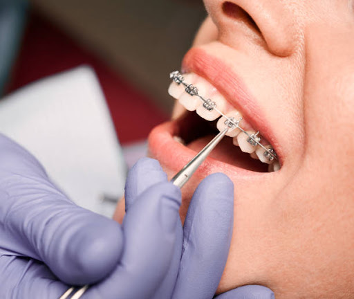 Braces for Teeth Alignment
