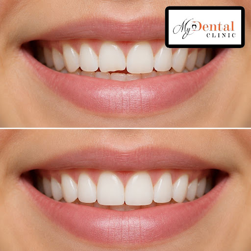 Dreaming of a smoother, more even smile without major dental work? Teeth reshaping at My Dental C… post image