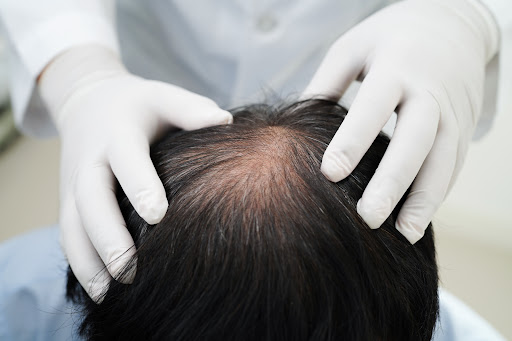 Alopecia areata is a condition in which the immune system mistakenly affects hair follicles, lead… post image
