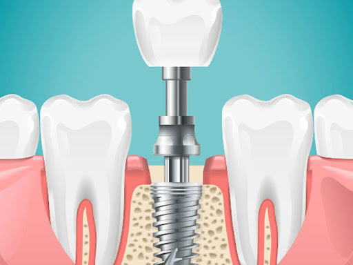 Welcome to the Best Dental Clinic in Dwarka Sector 7, led by the renowned Dr. Vaibhav Malik. We a… post image