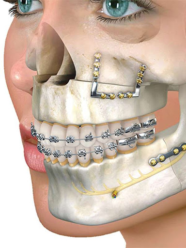 Maxillofacial surgery is a specialized field that addresses a variety of conditions affecting the… post image