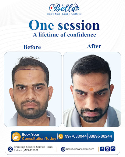 Looking for effective PRP treatment for hair fall, thinning hair, or hair restoration? Bella Skin… post image