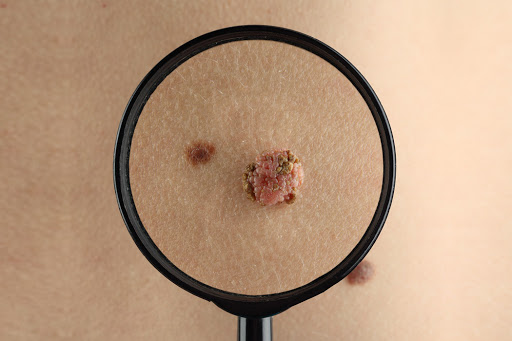 Skin Cancer Care NT - Thumbnail