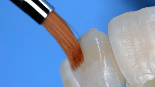 Photo n°1 de Dr Alix Devictor - Esthétique du sourire - Facette - Facettes pelliculaires - Implants dentaire - Greffe de gencive à Marseille (Cabinet d'implants dentaires)