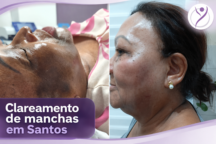 Procedimento realizado na Yara Estética
