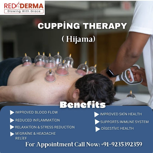 Cupping therapy (Hijama)