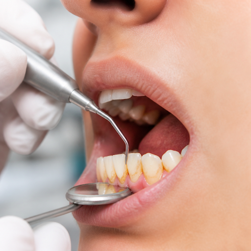 Healthy gums are the foundation of a beautiful smile. At Vinayak Dental And Implant Centre in Old… post image