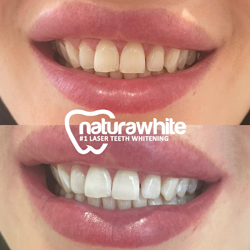 Naturawhite Laser Teeth Whitening Caernarfon - Thumbnail