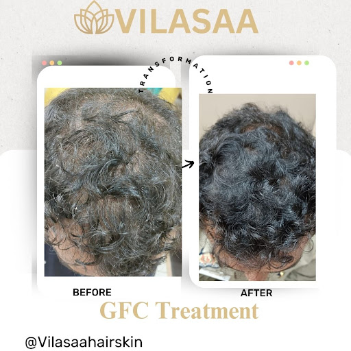 ✨ Exclusive PRP Offer at VILASAA Hair & Skin Centre, Ghaziabad! ✨