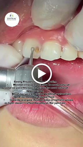 Tooth Cavity Restoration 🦷 post image