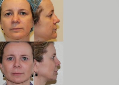Photos of Reza Nabavian MD : Breast Augmentation, Liposuction, Tummy Tuck