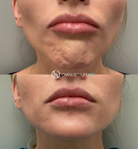 OMNI SCULPT MD: Med Spa