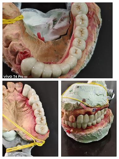 Fixed prosthesis 🦷