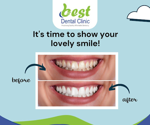 Over time, our teeth can discolor due to aging, genetics, the foods we eat or smoking. It is best… post image